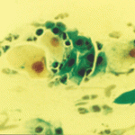 Πυρηνες με φαινόμενο ΄΄θολού γυαλιού΄'